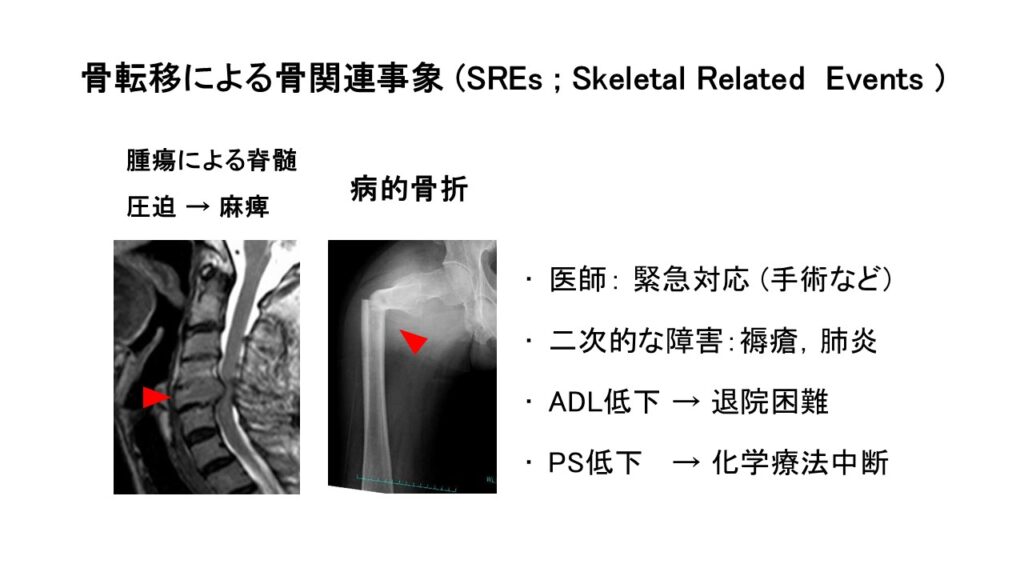 骨転移による骨関連事象 (SREs ; Skeletal Related  Events )