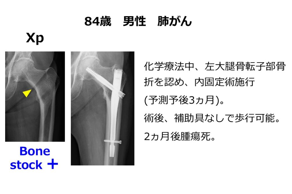 肺がん　事例