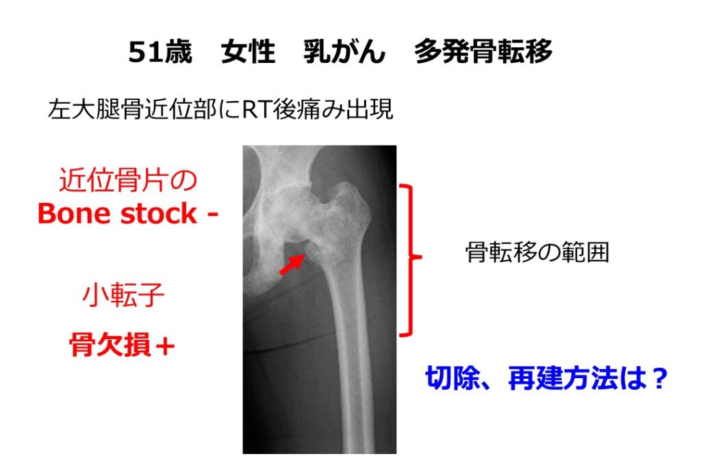 乳がん　多発骨転移　事例