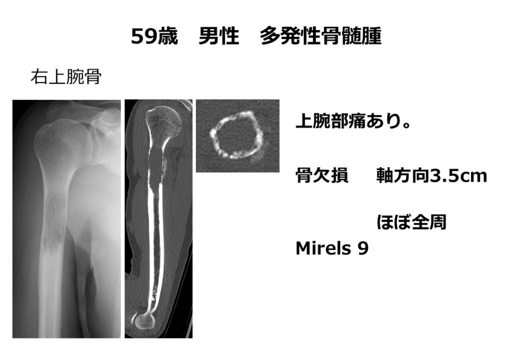 多発性骨髄腫　事例