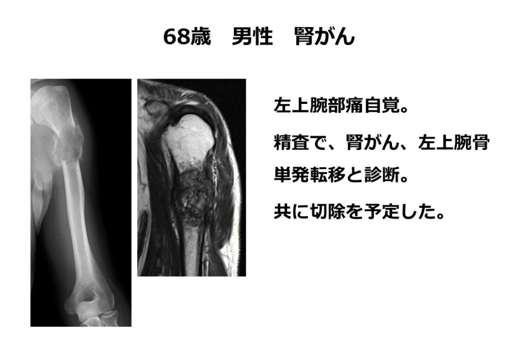 腎がん　事例